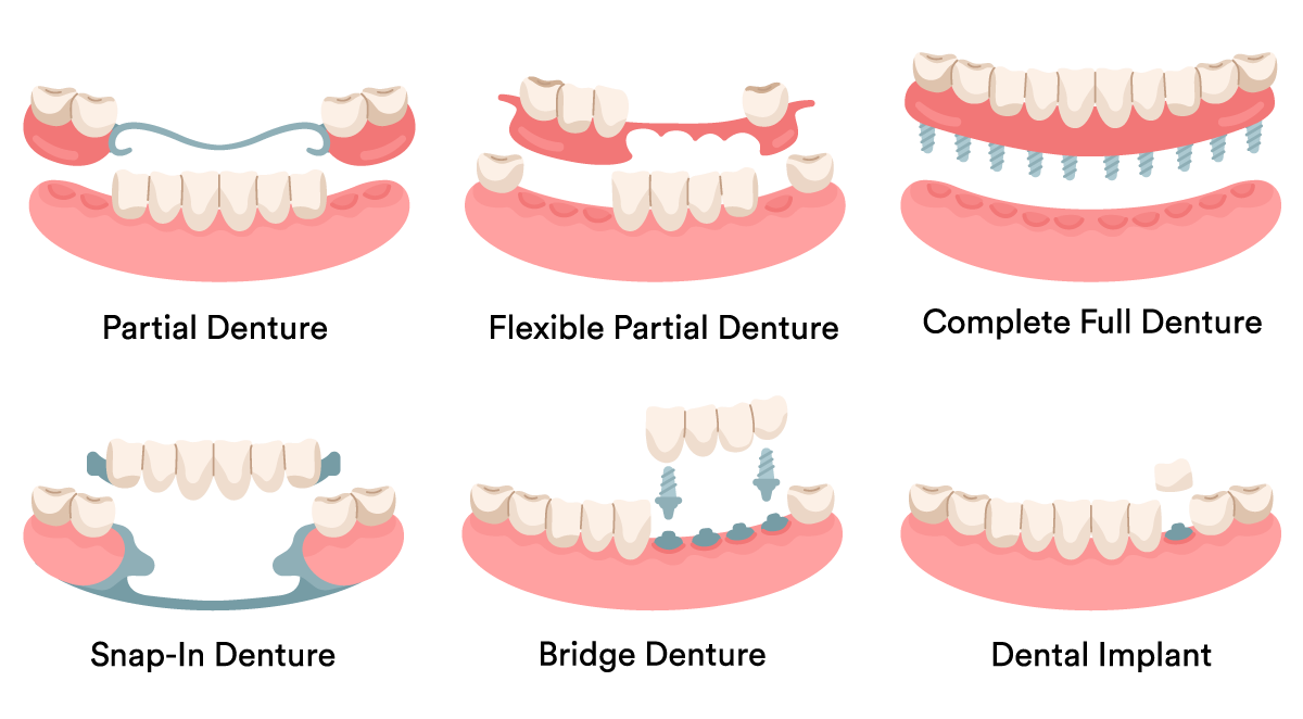 types-of-dentures