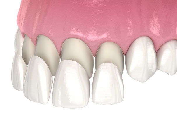 porcelain-veneers