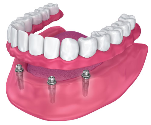 dentures-light-dental-studios Light Dental Studios