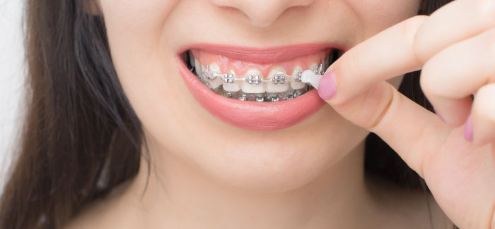 orthodontic-wax Light Dental Studios