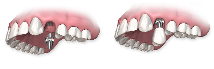 dental-implant-process-02