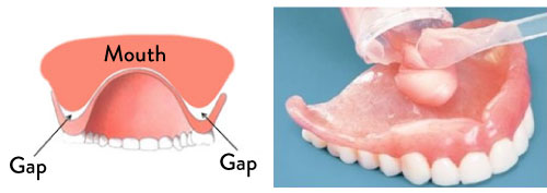 denture-reline-light-dental-stud