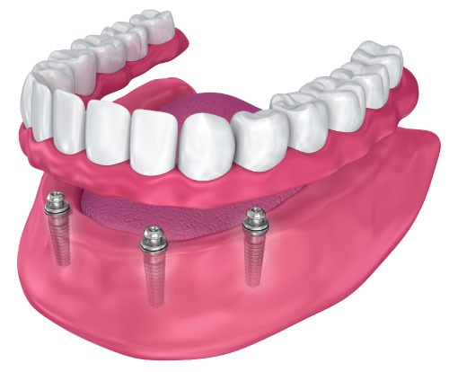 dentures-light-dental-studios