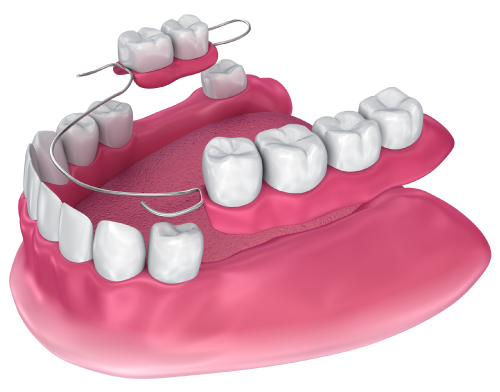 partial-dentures-light-dental-st