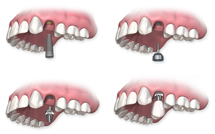 dental-implants