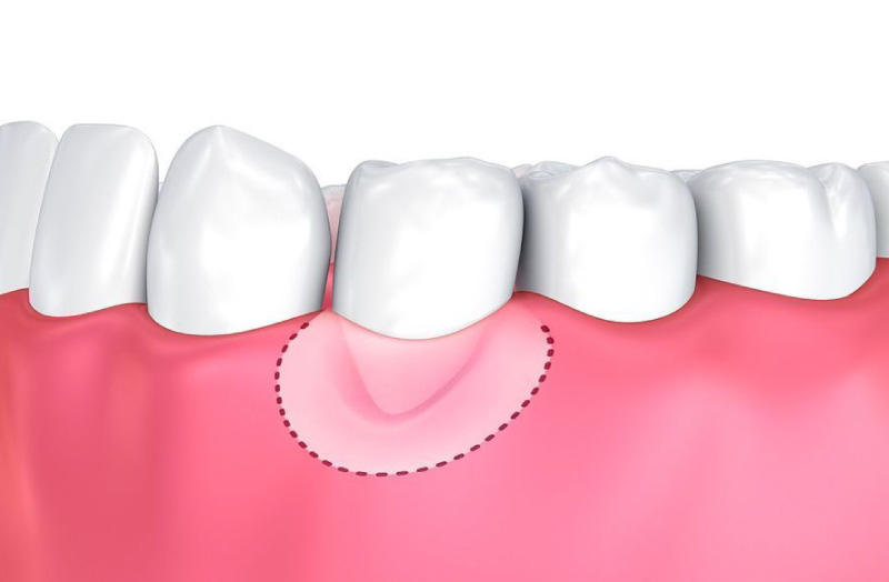 olympia-gum-grafting Light Dental Studios