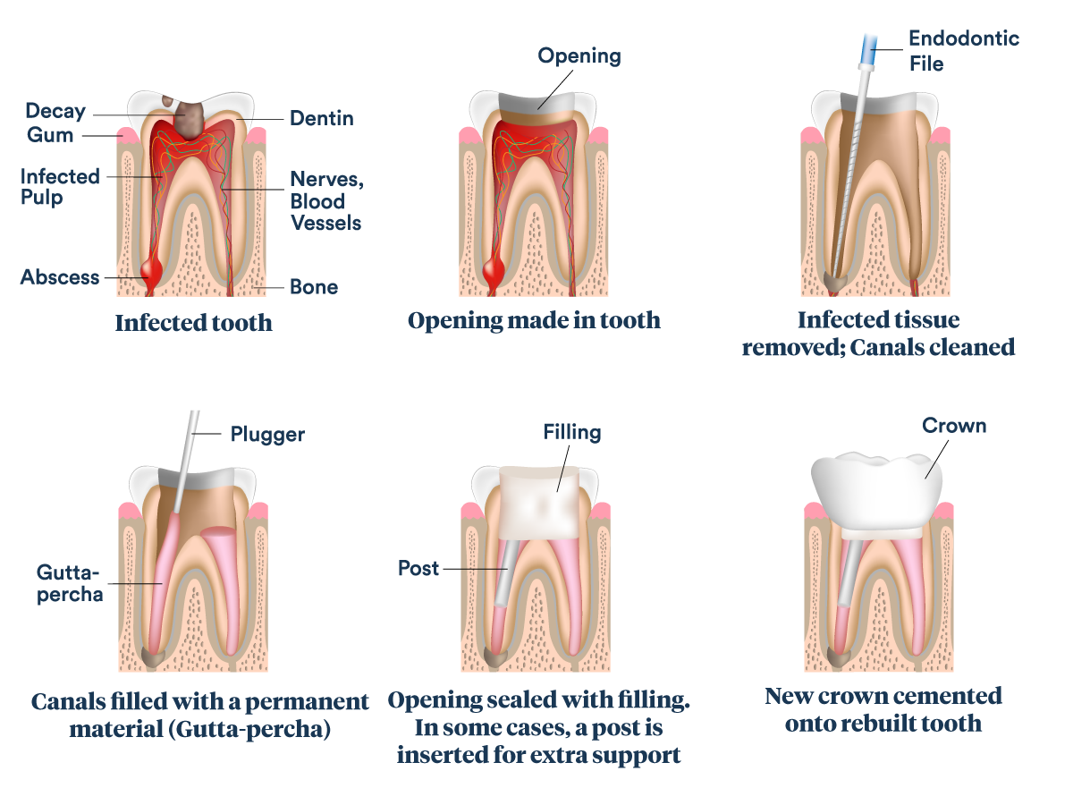 root-canals Light Dental Studios