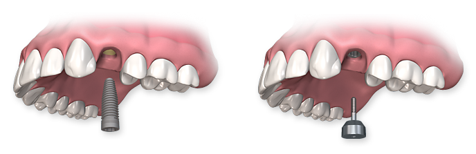 dental-implant-process-01 Light Dental Studios