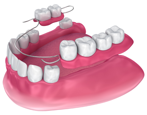 partial-dentures-light-dental-st Light Dental Studios
