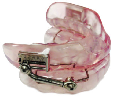 somnodent-herbst-advanced Light Dental Studios