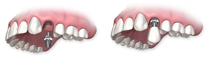 dental-implant-process-02