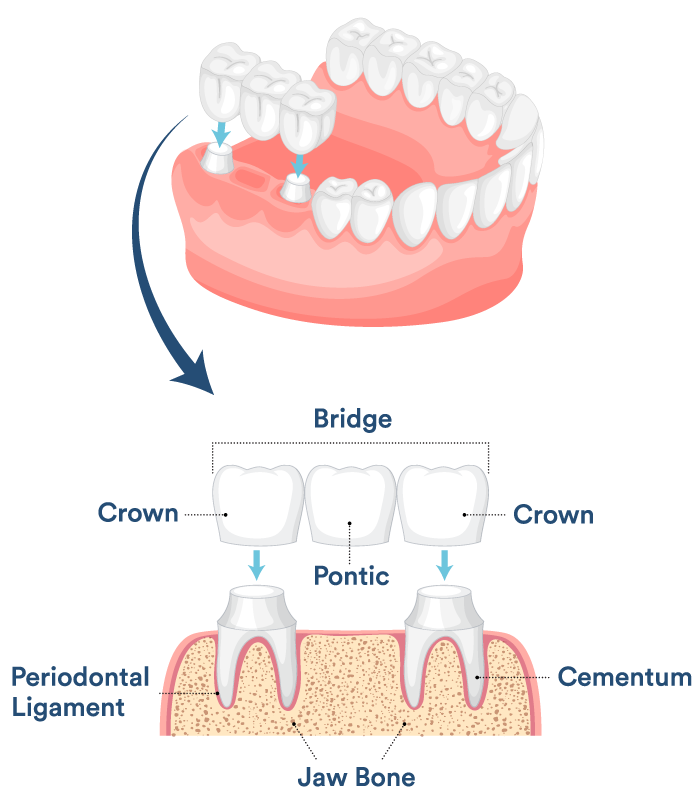 Dental Bridges