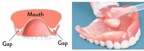 Denture Reline