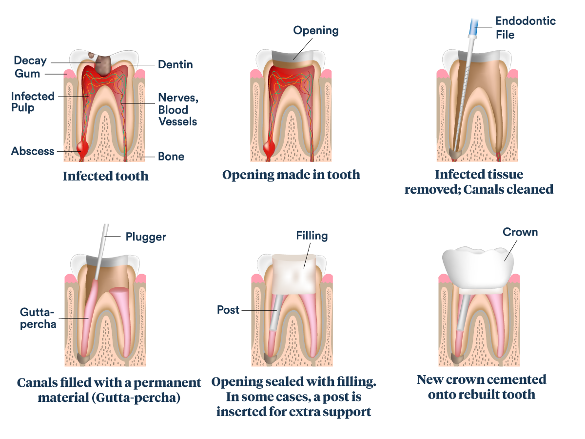 Root Canals