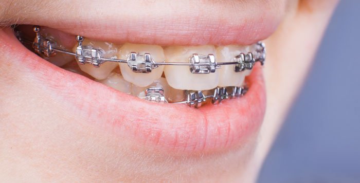 Traditional Metal Braces